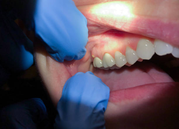 Best Emergency Tooth Extraction in Healdton, OK