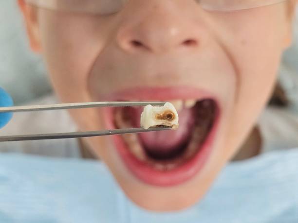 Best Emergency Treatment for Dental Infections or Abscesses in Healdton, OK